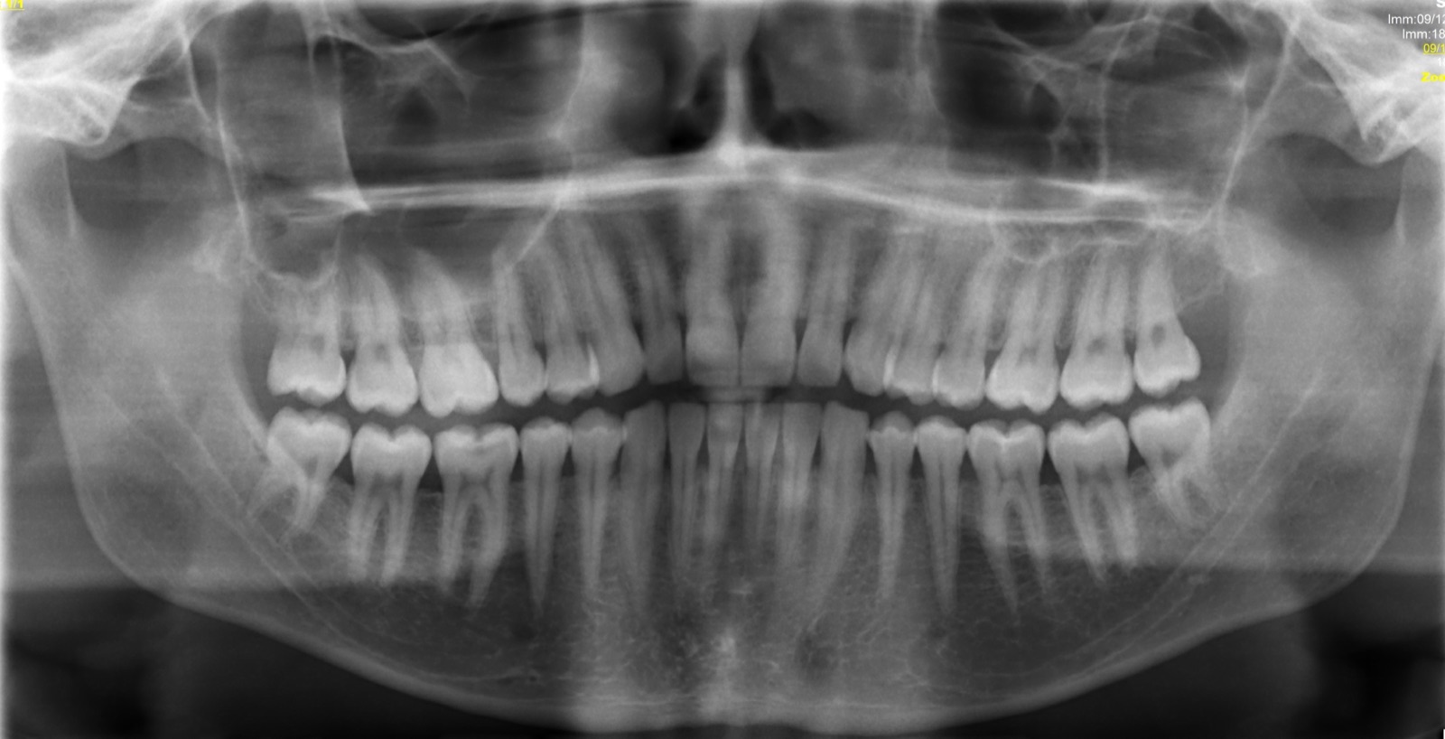 Panoramic dental X-ray showing a full set of teeth